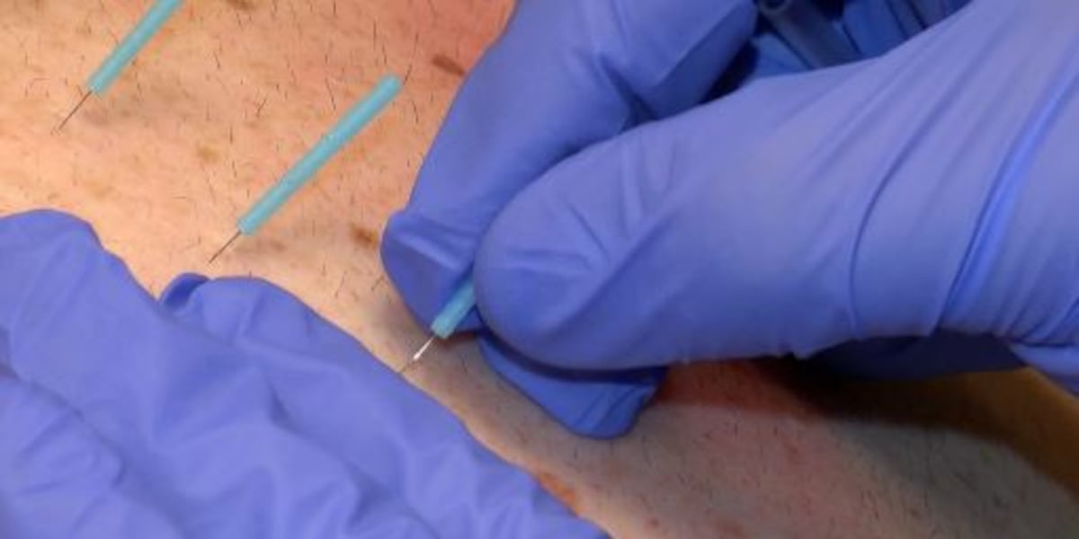 Dry needling and chiropractic care offered at Hammond-Henry Hospital