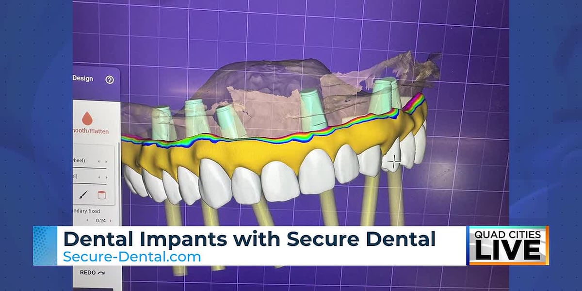Tooth Rag Dental implants explained: Secure Dental shares key facts for missing ...